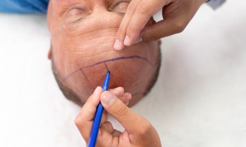 Corso sulle protesi capillari